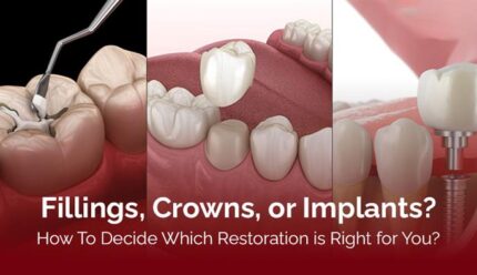 Fillings, Crowns or Implants- How to Decide Which Restoration is Right for You?